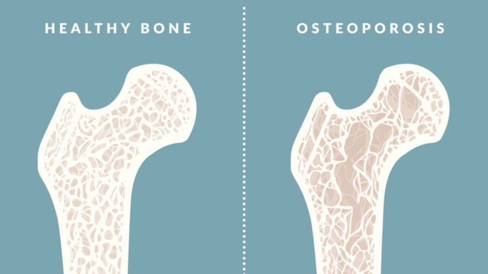 Osteographic